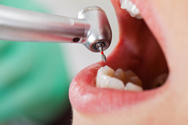 Best Chipped Tooth Repair Near Me  in Reynolds Heights, PA